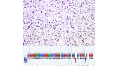 New CAP Guideline Improves Testing, Care, for Patients with Diffuse Gliomas